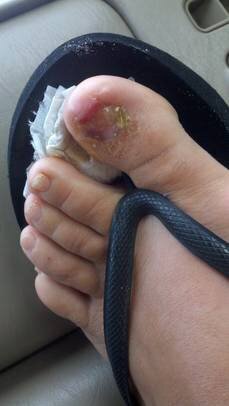 kimmis toe.jpg