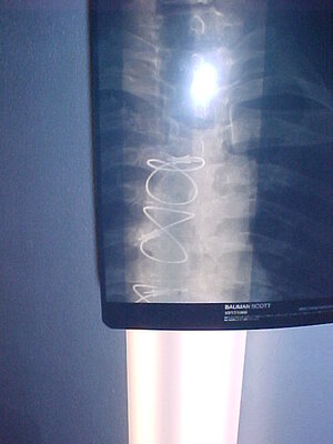 Jan 2007 X-ray.JPG